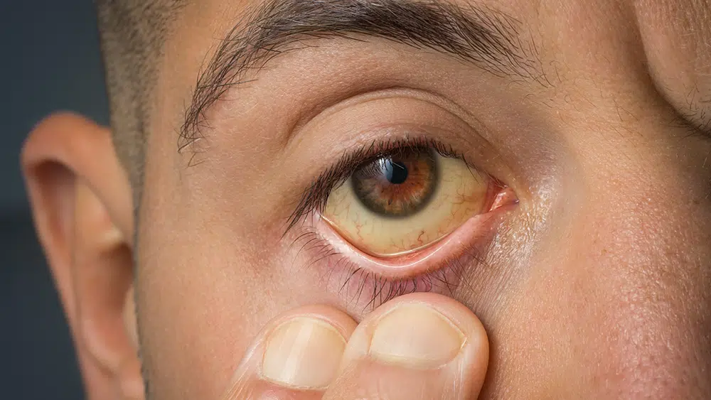 Top Causes of Jaundice in Adults and How to Manage Them